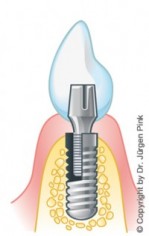 AAufbau eines Zahnimplantats