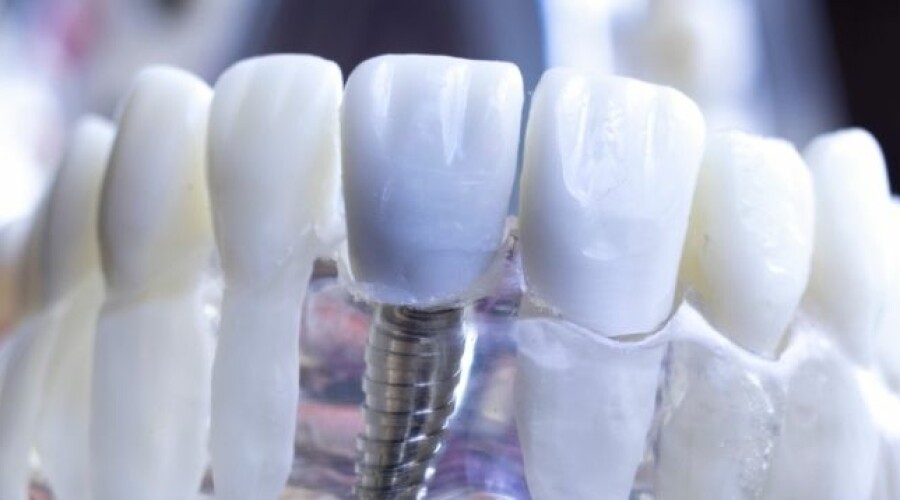 Haltbarkeit von Zahnimplantaten: Worauf Sie achten müssen