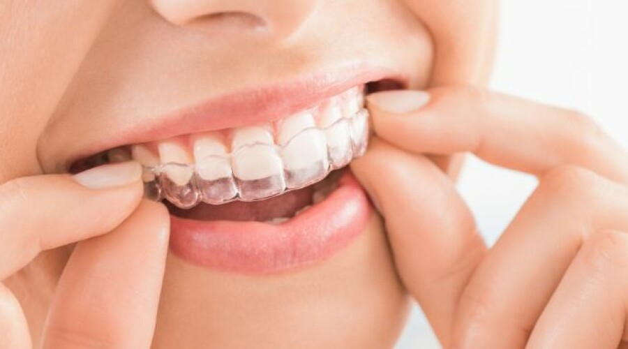 Transparent dental splints: Invisalign treatment in Munich